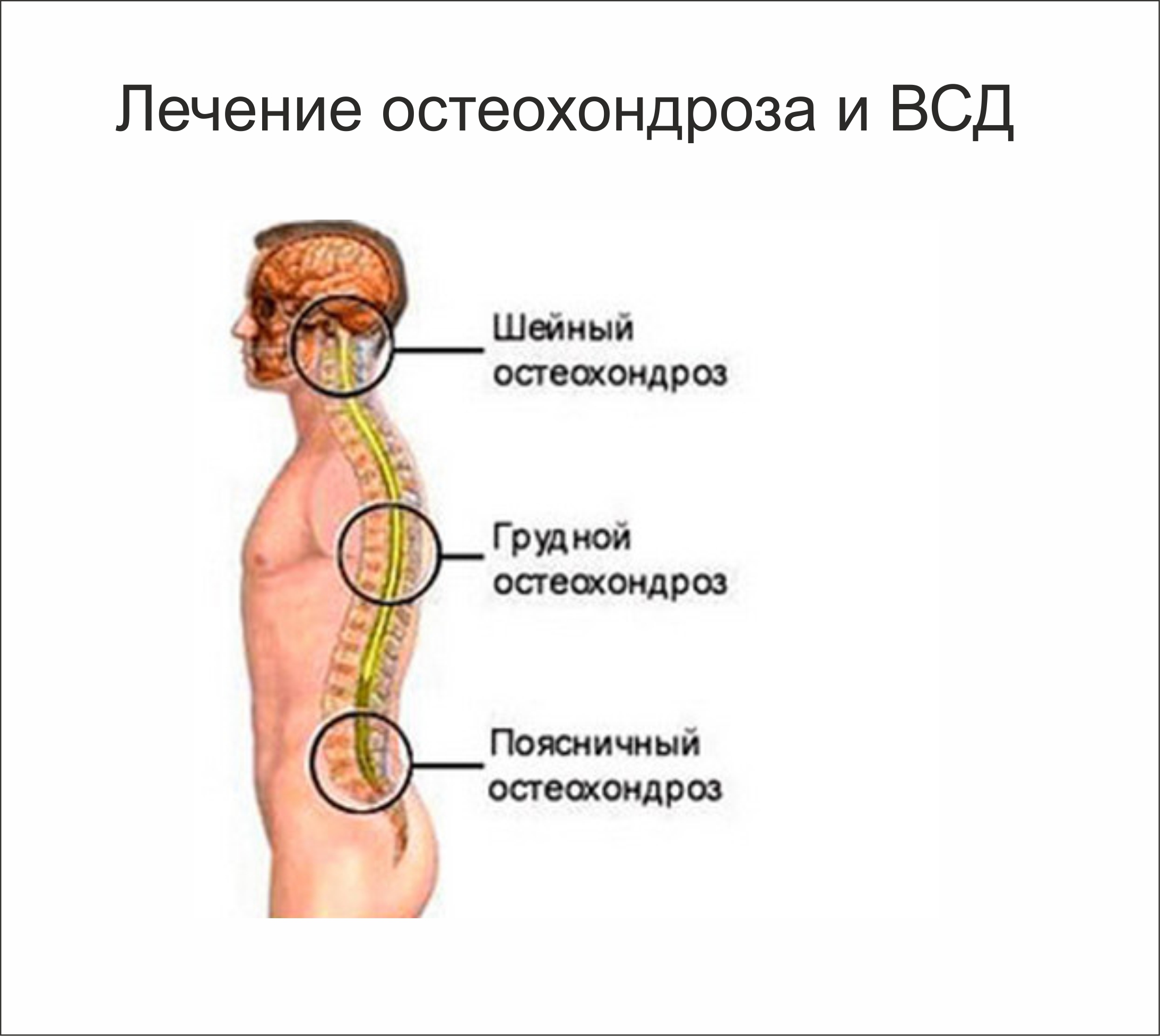 Что такое всд и шейный остеохондроз симптомы Что такое всд и шейный остеохондроз симптомы